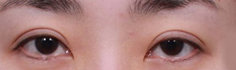조기재수술전 (수술3개월미만)